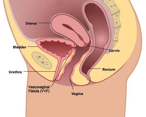 Vesicovaginal And Ureterovaginal Fistula2